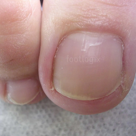 Footlogix Toe Nail Tincture